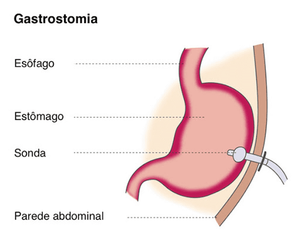 gastrostomia colocacao estomago