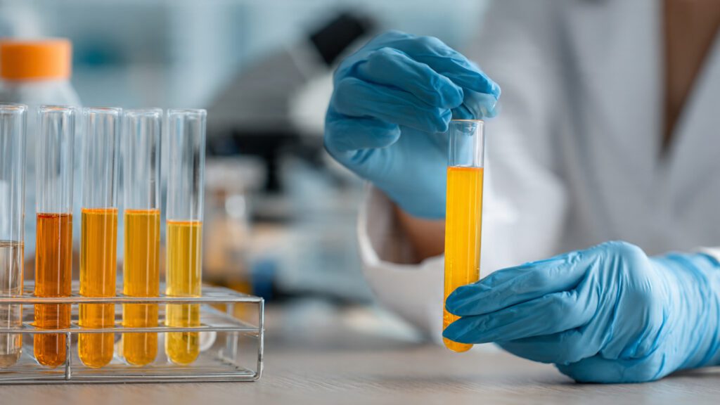 análise de exame de urina para diagnóstico de infecção urinária
