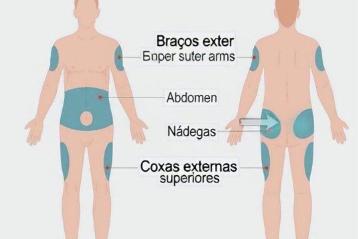 locais recomendados para injecao de insulina edited