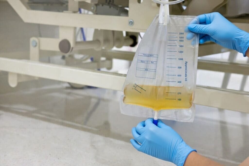 cuidados de enfermagem com sonda vesical de demora — posicionamento da bolsa coletora e monitoramento da diurese