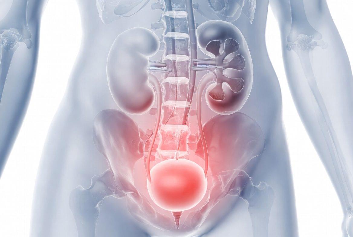 Ilustração médica do sistema urinário com foco em cistite (infecção urinária).