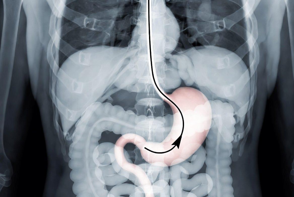 Como medir a sonda nasoenteral