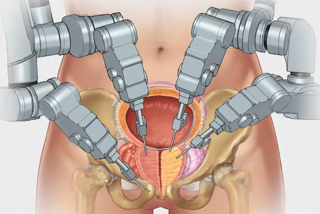 Ilustração médica detalhada mostrando a prostatectomia robótica, com braços robóticos operando com precisão e visão anatômica da próstata.